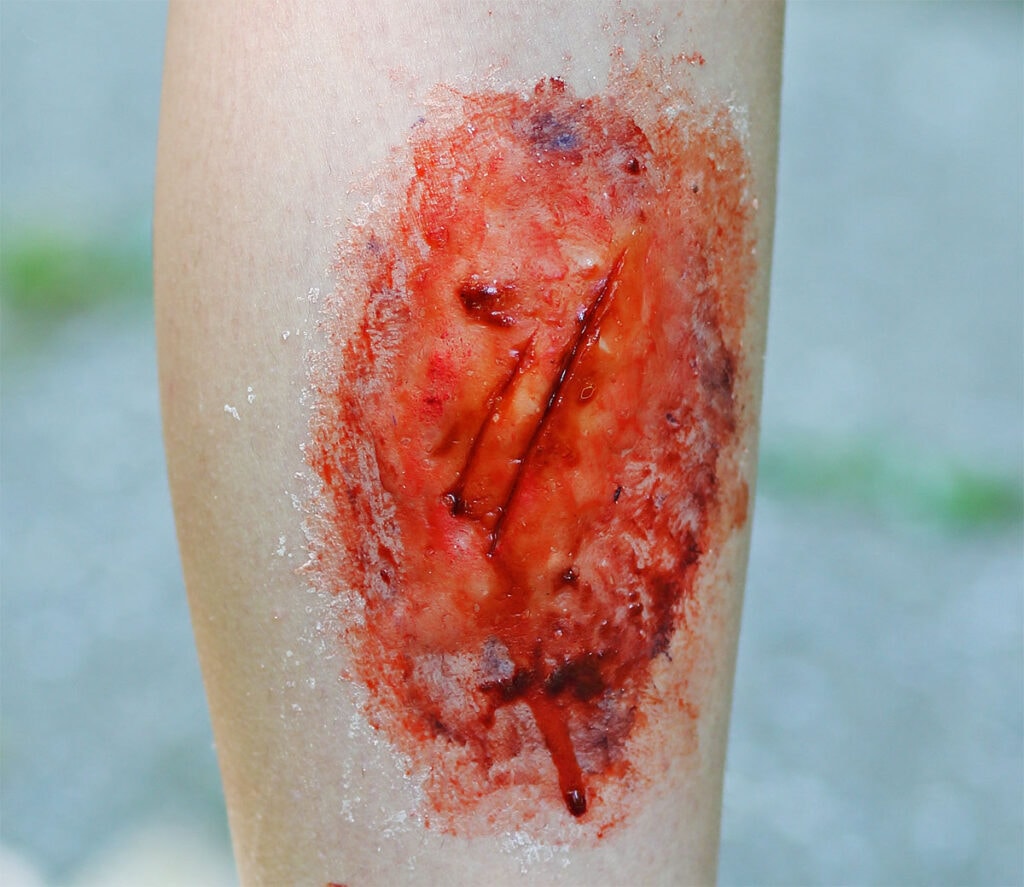 An Overview of Cellulitis