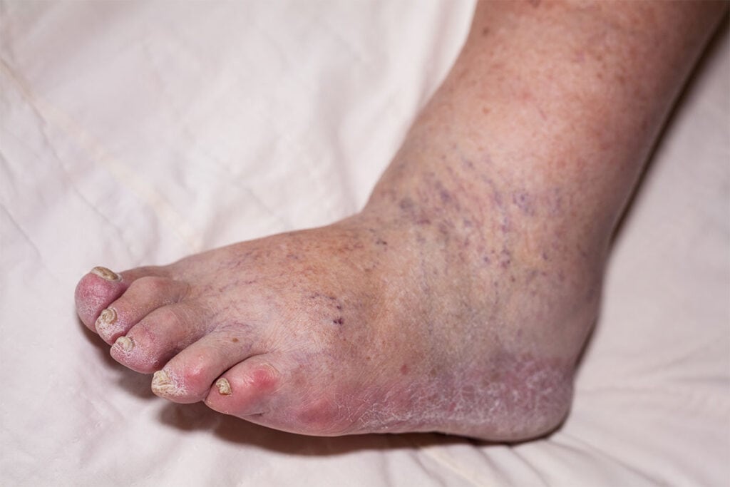 Types of Fungal Infections, Causes, and Treatments